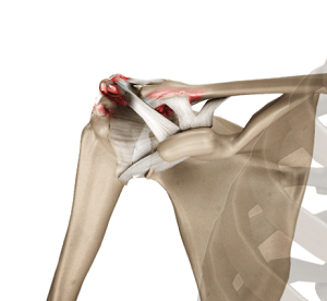 AC (Acromioclavicular) Joint Arthritis