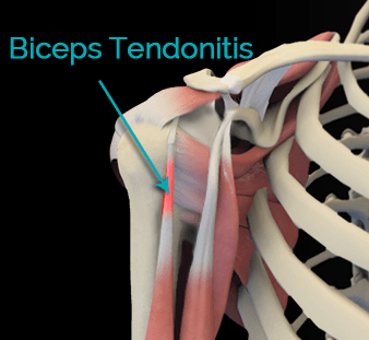 Bicep Tenodesis