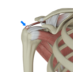 Calcific Tendinitis