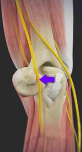 Cubital Tunnel Release Surgery  