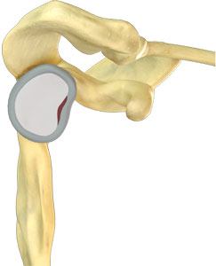 Labral Repair 