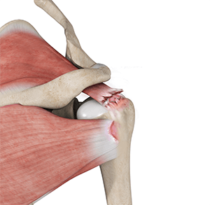 Rotator Cuff Arthropathy