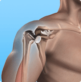 Total Shoulder Replacement