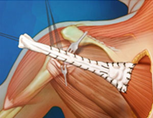 Lower Trapezius Tendon Transfer 
