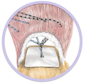 Arthroscopic Rotator Cuff Repair