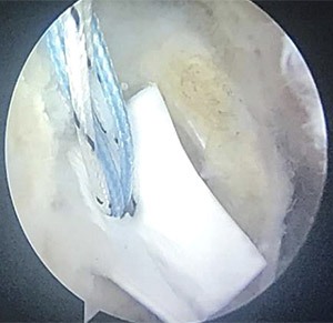 Arthroscopic Rotator Cuff Repair