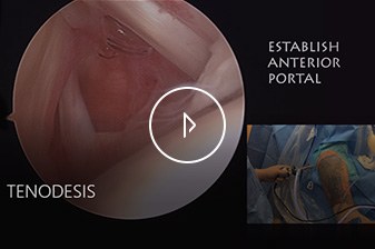 Arthroscopic Bicep Tenodesis